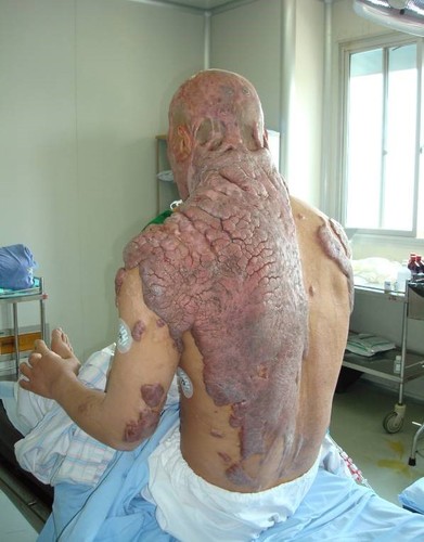 硫酸重度烧伤的人图片